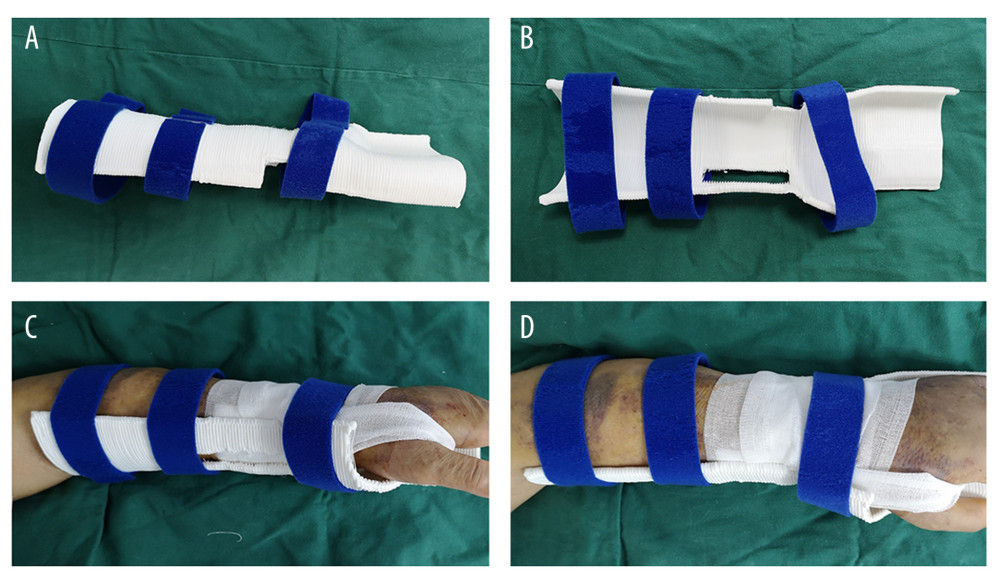 (A–D) Application of the 3-dimensional printing appliance system for distal radius fracture.
