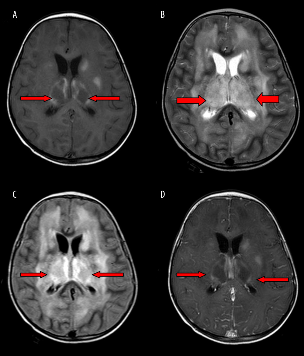 A 3-year-old boy with acute necrotizing encephalitis, with fever for 2 days and convulsion once. The thalamus was swollen. Symmetrical and multifocal involvement was observed in bilateral thalamus and paraventricular (A. T1WI; B. T2WI; C. T2WI-FLAIR), and no enhancement was observed in all lesions (D) (T1WI contrast enhancement). Axial T1WI (A) showed the tricolor pattern in thalamic lesions.