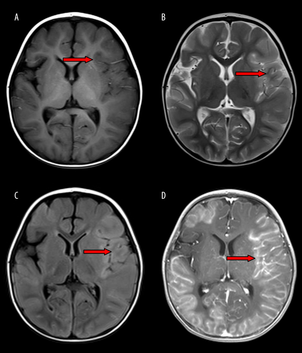 A 11-month-old girl with influenza-associated encephalopathy (IAE), with fever for 2 days, no convulsion. Multiple gyrus swelling and abnormal signals were observed in bilateral cerebral hemispheres, with low signal on T1WI (A) and high signal on T2WI (B) and T2WI-FLAIR (C), more obviously on the left side. Diffuse enhancement was observed on T1WI contrast enhancement (D) in lesions of the gyrus and pia meninges.