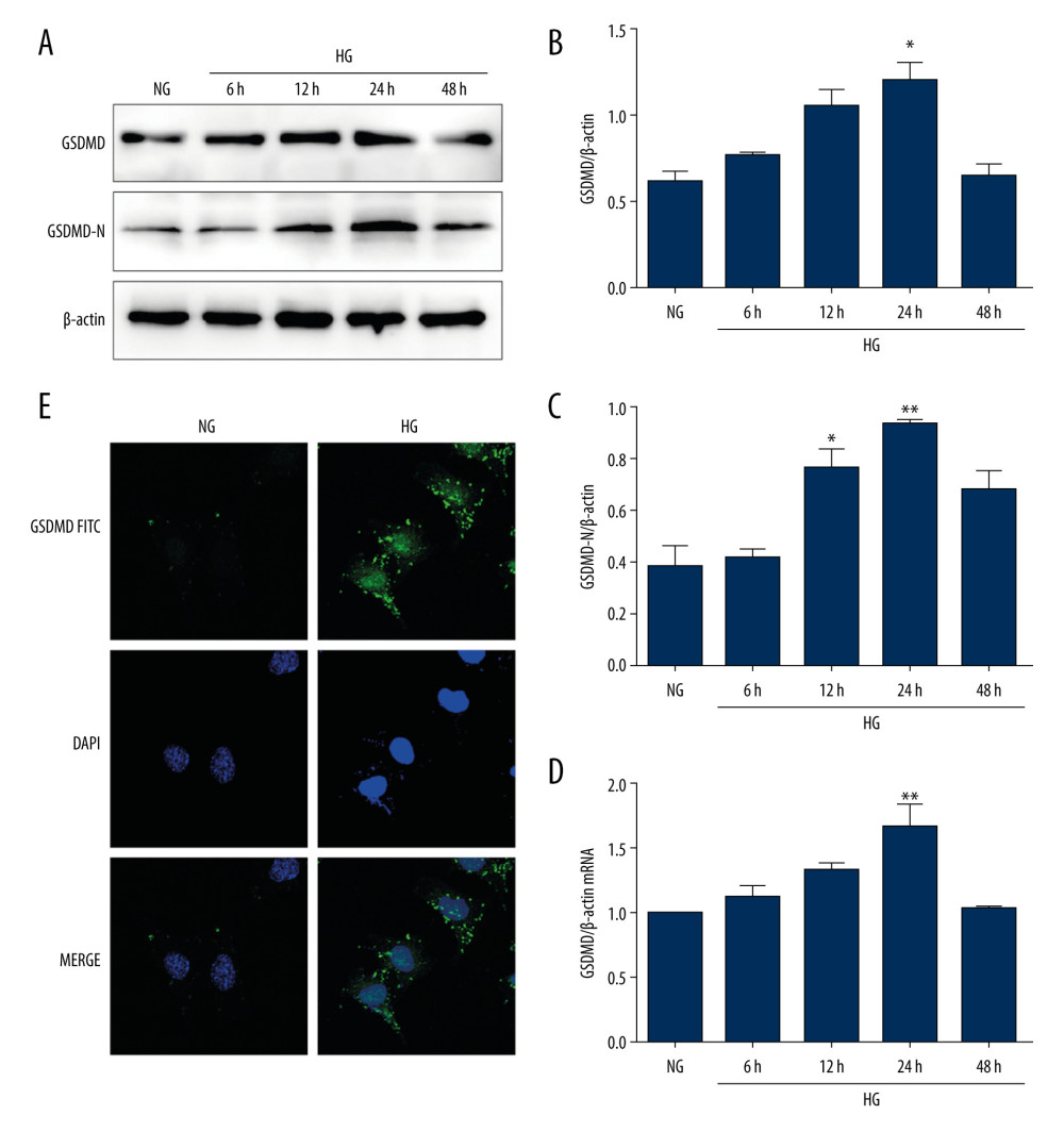 Activation of GSDMD in HG-cultured mouse podocytes at various time points. (A–C) Western blot showing GSDMD and GSDMD-N protein expression levels in NG and HG-cultured mouse podocytes. (D) The expression of GSDMD-N mRNA was determined by RT-qPCR. (E) The expression of GSDMD in mouse podocytes was detected by immunofluorescence. NG – normal-glucose; HG – high-glucose; Data represent the average of 3 measurements. Mean±SD of 3 experiments is shown. * P<0.05, ** P<0.01 vs NG.