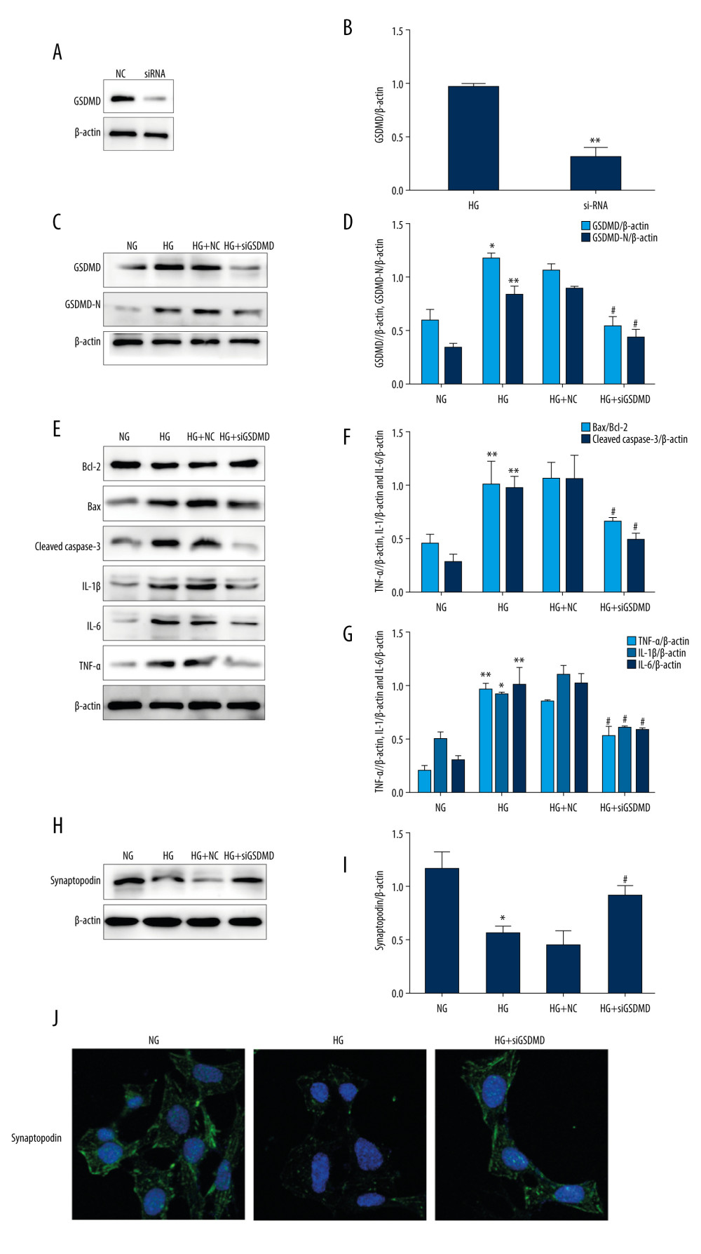 Effects of GSDMD gene knockout on inflammation and apoptosis in mouse podocytes induced by HG. (A–D) The expression of siGSDMD protein was detected by western blot. (E–G) The activity of Bax, Bcl-2, cleaved caspase-3, IL-1β, IL-6, and TNF-α was evaluated by western blotting. (H–J) The activities of synaptopodin in mouse podocytes was evaluated by western blotting and immunofluorescence. NC – siRNA negative control; siRNA – GSDMD siRNA (20 μM); NG – normal-glucose; HG – high-glucose; HG+NC – high-glucose+siRNA negative control; HG+siGSDMD – high-glucose (30mM)+GSDMD siRNA (20 μM). Date represent the average of 3 measurements. Mean±SD of 3 experiments is shown. * P<0.05, ** P<0.01 vs NG, # P<0.05 vs HG.