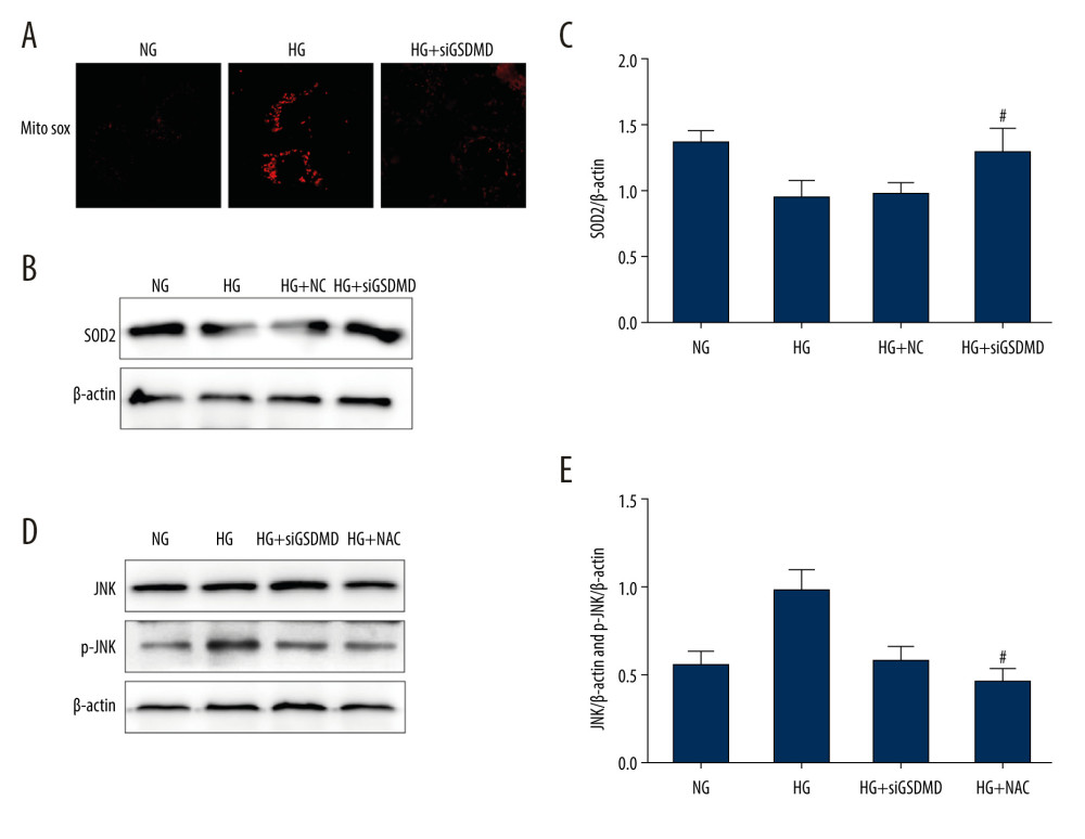 Effect of GSDMD knockdown on HG-induced mitochondrial ROS production and p-JNK expression levels in mouse podocytes. (A) Mitochondrial ROS production was measured using a confocal microscope. (B, C) SOD2 activity was evaluated by western blotting. (D, E) The protein activity of JNK and p-JNK was detected by western blotting. NG – normal-glucose; HG – high-glucose; HG+siGSDMD – high-glucose+siGSDMD; HG+SP – high-glucose+SP600125. Data represent the average of 3 measurements. Mean±SD of 3 experiments is shown. (C) * P<0.05 vs NG, # P<0.05 vs HG; (E) * P<0.05 vs HG, # P<0.05 vs HG.