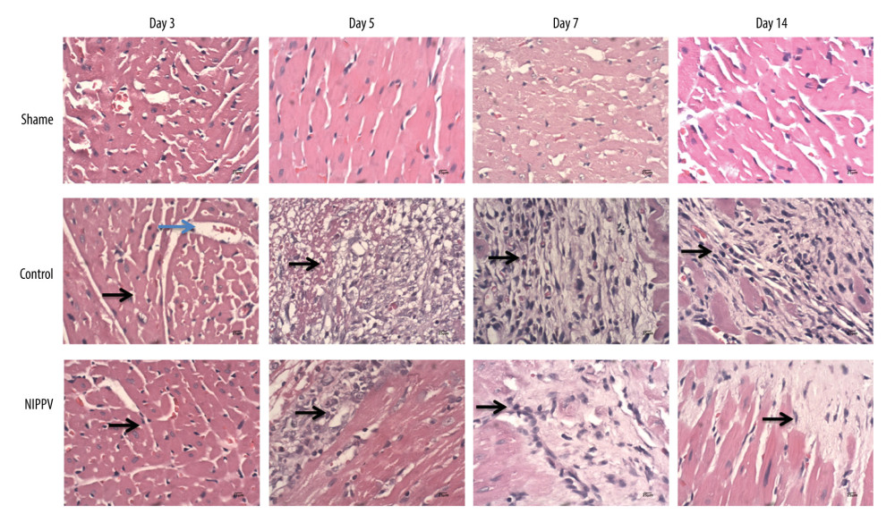 Hematoxylin and eosin (H&E) staining of cardiomyocytes at each time point in 3 rats of each group. No significant change in the cardiomyocytes of the sham group on days 3, 5, 7, and 14. Neutrophil aggregation and myocardial fibrosis were found in the control group. In the noninvasive positive-pressure ventilation group, the neutrophils scattered and myocardial degeneration was not obvious. H&E, ×100. Neutrophils, blue arrow; lymphocytes, black arrows.