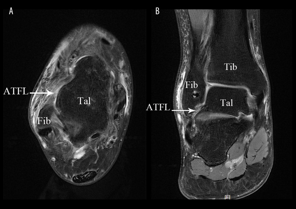 Arthroscopic technique approaches. (A) Physical image of arthroscopic approach; (B) 3D Print Model of Surgical Approach. TA – tibialis anterior; LM – lateral malleolus; Approach MM – medial midline approach; ACAL – accessory anterolateral approach; IER – inferior extensor retinaculum; ATFL – anterior talofibular ligament.