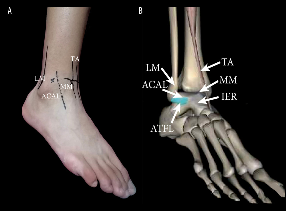 Medical Science Monitor | Comparison of Arthroscopic Surgery Versus ...