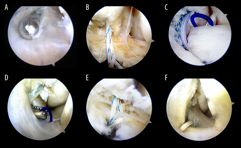 The procedure of all-arthroscopic repair of anterior talofibular ligament (ATFL) with anchors. (A, B) The procedure of arthroscopic repair of ATFL with anchors Arthroscopic placement of suture anchor at the fibular attachment point of ATFL through accessory anterolateral approach; (C) The needle was penetrated the ATFL after entering the articular cavity; (D) The PDS stature was pulled out via accessory anterolateral approach; (E) Repeat the above steps so that the anchor thread is passed through the ATFL and reinforced the IER; (F) Repeat steps to penetrate the other suture was penetrated the ATFL and fixed with top knot.