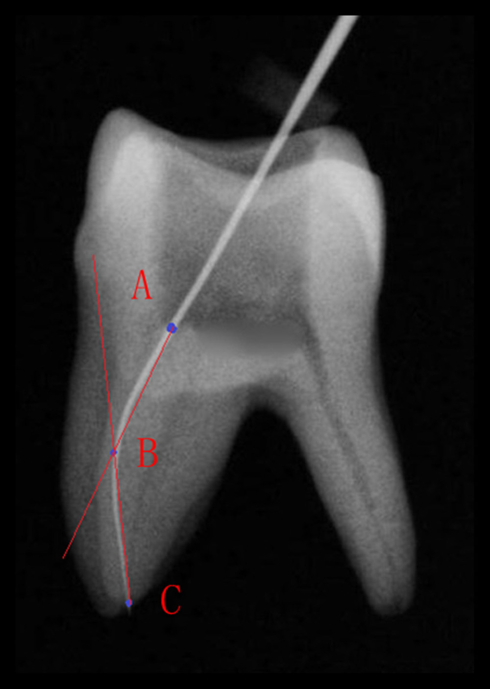 Root canal curvature measurement (Point A) the root canal orifice (Point B) the canal began to leave the long axis of the tooth (Point C) the apical foramen