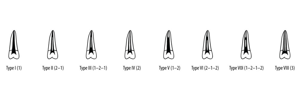 Illustration showing the categories of root canal morphologies in human permanent teeth according to the method by Vertucci.