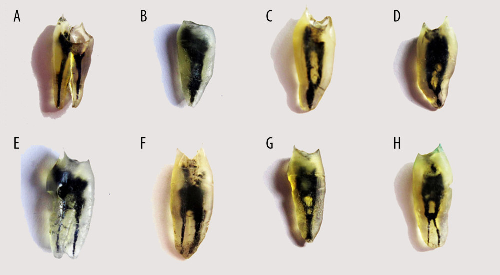 Representation of root canal types observed by transparent tooth method (A) Type I (1-1 double roots) (B) type I (1-1 single root) (C) type II (2-1) (D) type III (1-2-1) (E) Type IV (2-2) (F) type V (1-2) (G) type VI (2-1-2) (H) type VII (1-2-1-2).