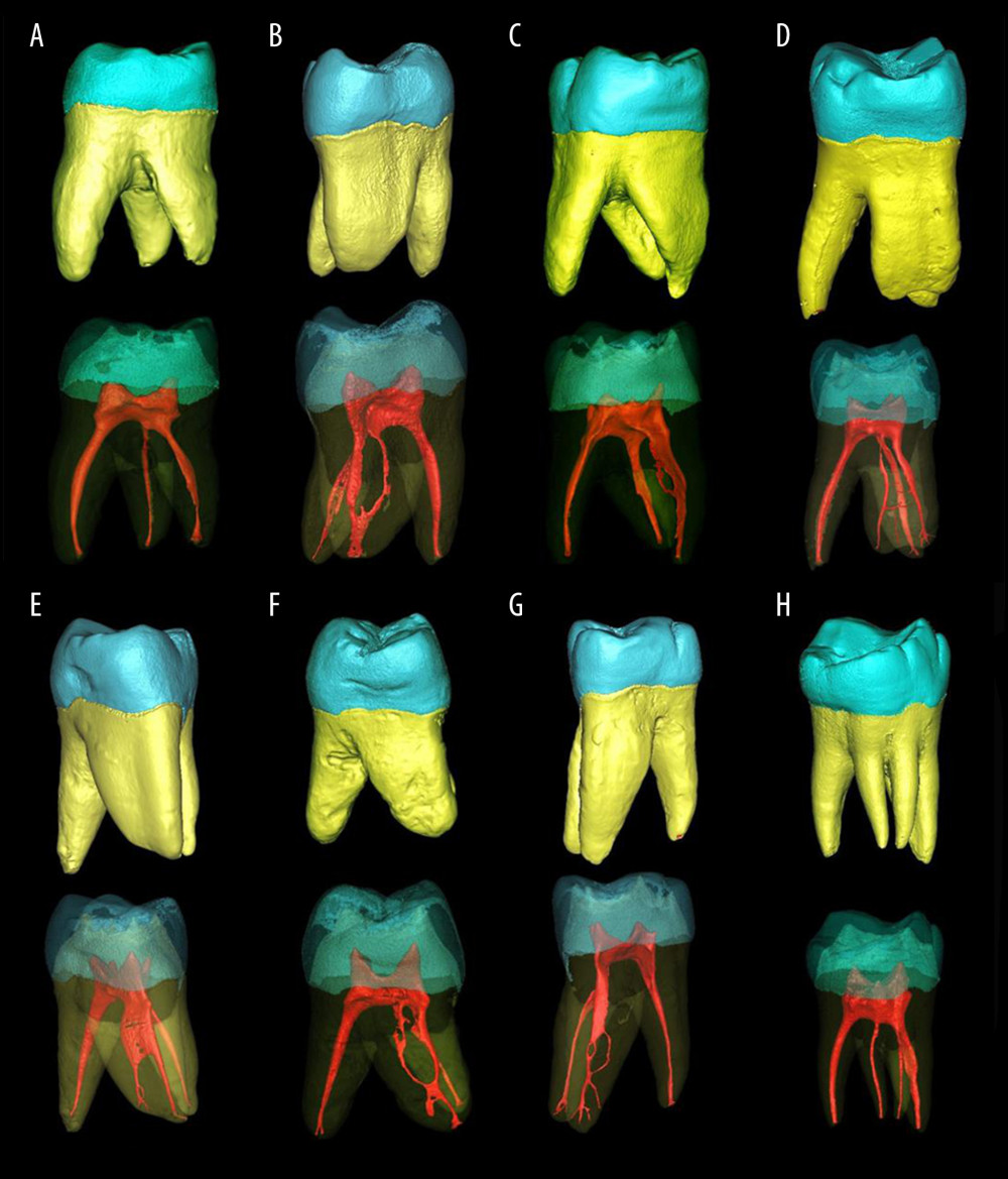 Representation root canal morphology by micro-CT (A) Type I (1-1) (B) Type II (2-1) (C) Type III (1-2-1) (D) Type IV (2-2) (E) type V (1-2) (F) type VI (2-1-2) (G) type VII (1-2-1-2) (H) Double root of mesial buccal (1-1 root canal).