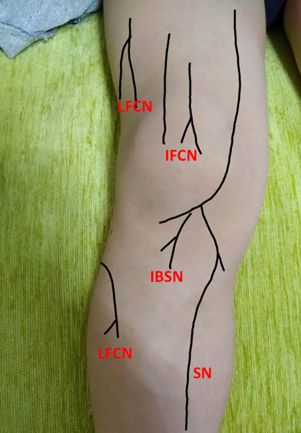 Tender chronic constrictive injury (CCI) points. LFCN – lateral femoral cutaneous nerve; IFCN – intermediate femoral cutaneous nerve; IBSN – infrapatellar branch of saphenous nerve; SN – saphenous nerve.
