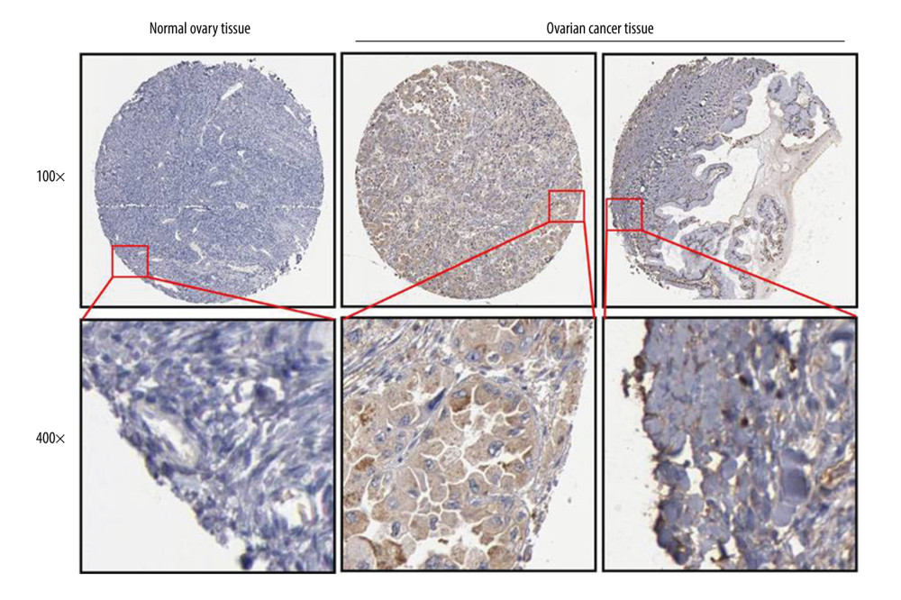 FOXA2 protein expression detected with an immunohistochemistry assay in normal and cancerous ovarian tissue.