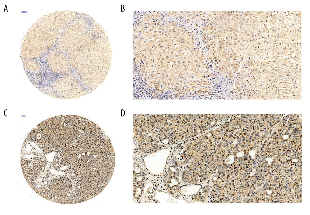 The Cdc45 expression levels for the in-house tissue microarrays. Immunohistochemistry staining to evaluate the expression of Cdc45 in hepatocellular carcinoma (HCC) and adjacent tissues. (A, B) The expression of Cdc45 was absent or weak in the non-HCC tissue (2.565±1.410). (C, D) The expression of Cdc45 was obviously high in the HCC tissue (4.635±2.051). Cdc45 was detected in the nucleus and cytoplasm. Magnification, ×20 (A, C) and ×400 (B, D).