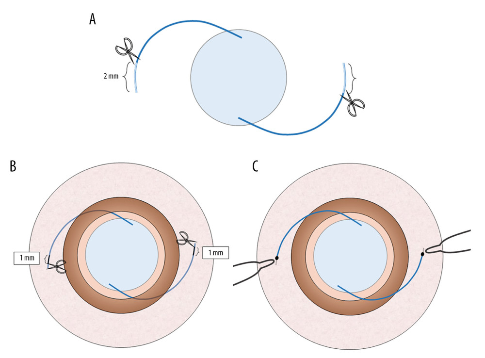 The diagrams show the double trimming of the haptics in the trimmed group. A 2.0-mm section was cut off the haptics before the IOL was inserted into the eye (A). Two 1.0-mm sections were marked at points from which the haptics passed through the sclera, and the unmarked parts were cut off (B). The 1.0-mm marks were cauterized to create flanges and fixed into the scleral tunnels (C).