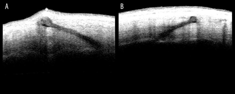 Anterior segment optical coherence tomography (AS-OCT) images show the location of the haptics. The flange of the untrimmed haptic is seen pushing up the partial sclera in (A). The flange of the trimmed haptic was well-fixed in the sclera in (B).