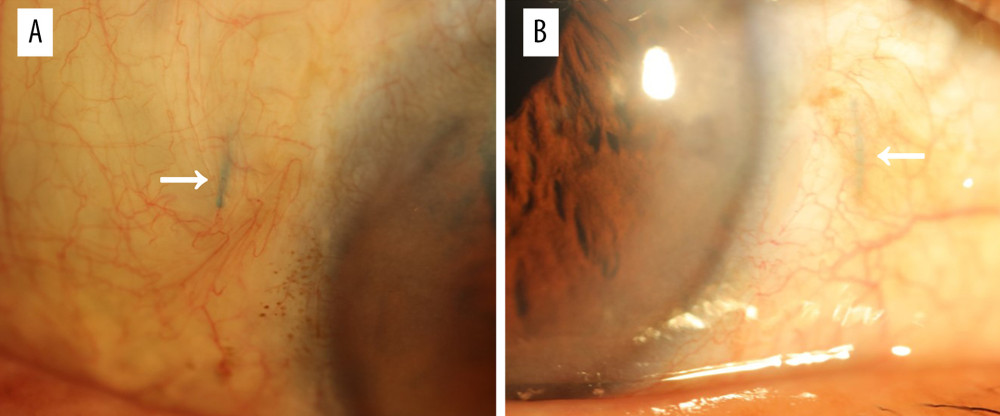 A slit-lamp microscopy image shows the subconjunctival haptic extrusion at the temporal side (A, arrow) and the nasal side (B, arrow).