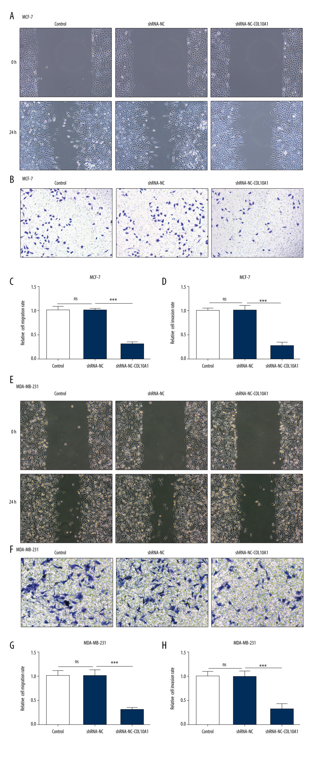 Downregulation of COL10A1 restrained the migration and invasion of breast cancer cells. (A, C) Wound healing assay was used to examine the effect of silenced COL10A1 on MCF-7 cell migration (100×). (B, D) Transwell assay was used to examine the effect of silenced COL10A1 on MCF-7 cell invasion (100×). (E, G) Wound healing assay was used to examine the effect of silenced COL10A1 on MDA-MB-231 cell migration (100×). (F, H) Transwell assay was used to examine the effect of silenced COL10A1 on MDA-MB-231 cell invasion (100×). *** p<0.001.