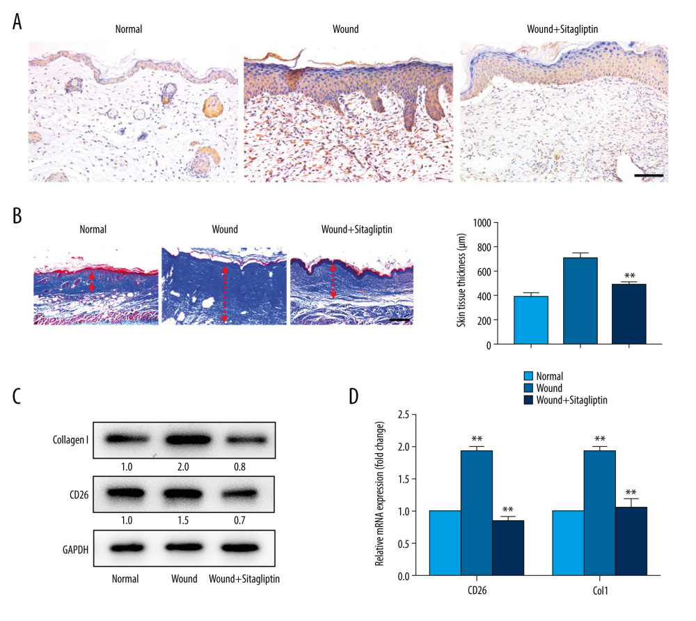 Pharmacological inhibition of CD26 inhibits collagen biosynthesis during skin wound healing and reduces scar formation. (A) Immunohistochemistry staining of CD26 in samples of normal skin, burn wounds, and wounds treated with sitagliptin. Scale bar: 100 μm. (B) Masson staining in samples of normal skin, burn wounds, and wounds treated with sitagliptin and its quantification (n=5). Scale bar: 200 μm. (C) The protein expressions levels of CD26 and Col1 in tissue samples following sitagliptin treatment were measured by western blot. Representative images are shown. (D) The mRNA expression levels of CD26 and Col1 were significantly decreased in samples of skin burn wounds following sitagliptin treatment (n=5). t test, * P<0.05 vs Normal group, ** P<0.01 vs Normal group.