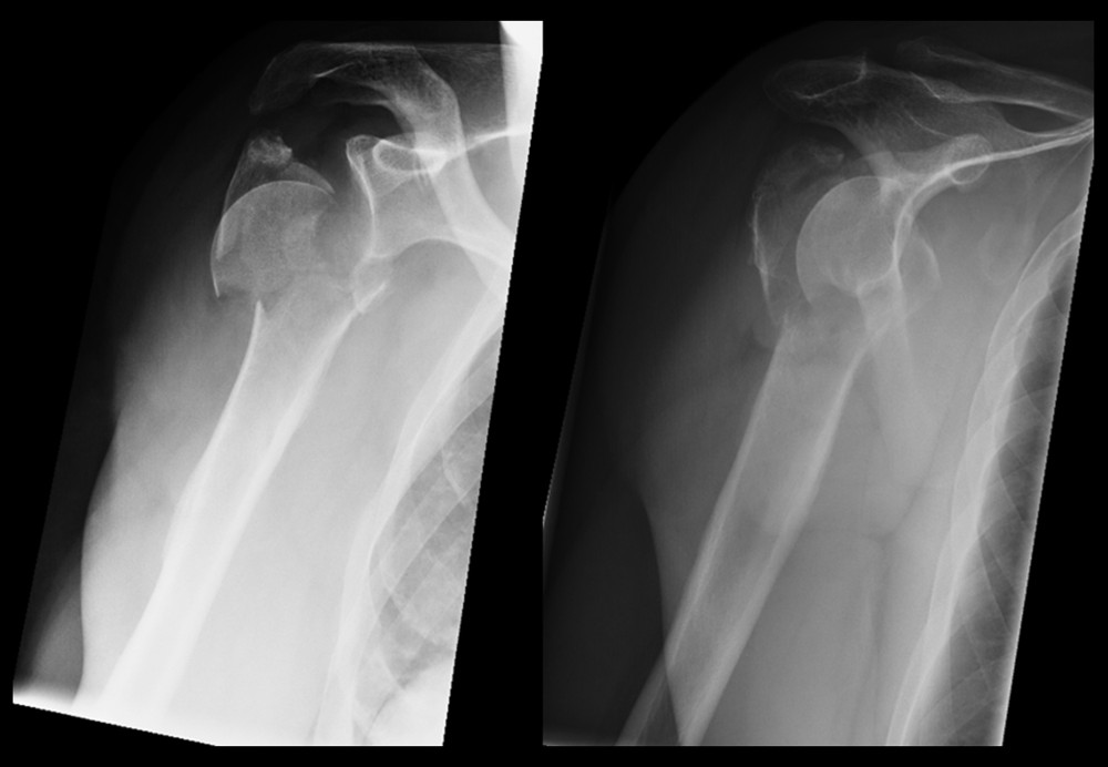 A 56-year-old patient with an avulsion of the coracoid process and a comminuted proximal humeral fracture (Neer V).