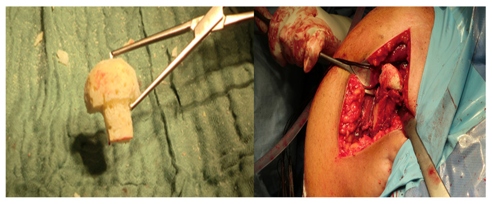 Trimming and inset of the lyophilized femoral bone allograft.