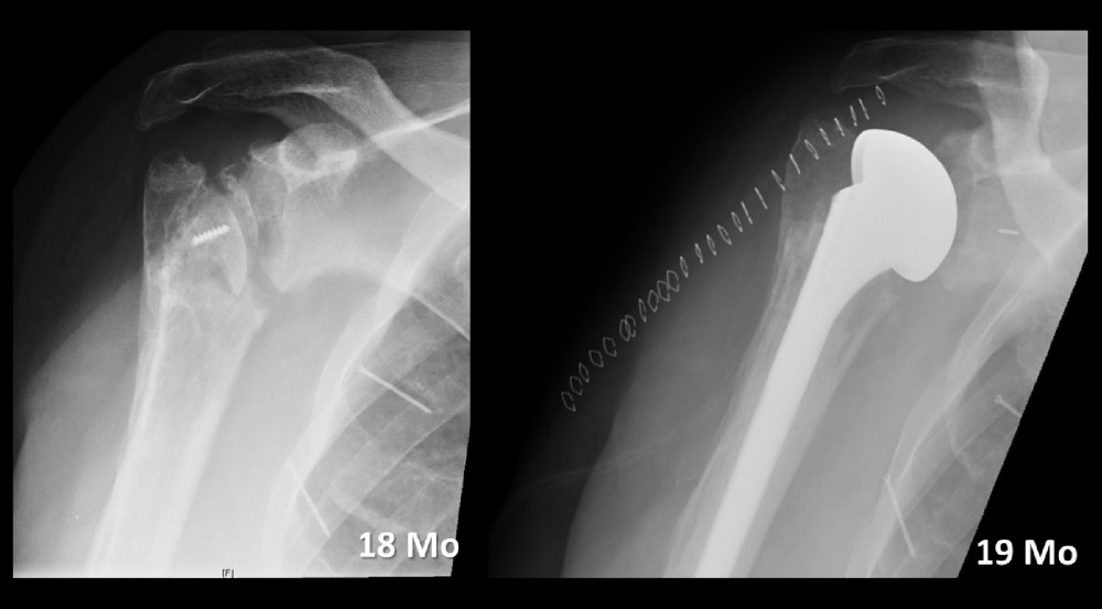 Necrosis of the humeral head necrosis was found at the 18-month follow-up. The patient underwent hemiprosthesis surgery.