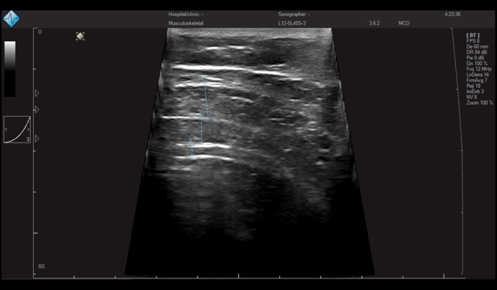 Ultrasound image of external oblique (EO), internal oblique (IO), and transverse abdominis (TrA). (1) EO, (2) IO, (3) TrA.
