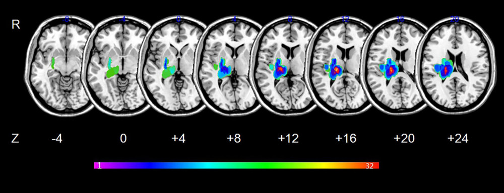 Lesion overlapped across the 34 stroke patients. Color bar indicates the number of subjects having lesions in each voxel.