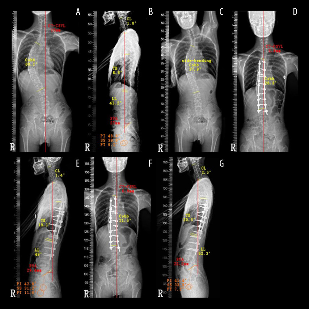 Representative case 1: an 18-year-old man with Lenke 1A adolescent idiopathic scoliosis. (A) Preoperative standing film showed a 15-mm center of a C7 plumb line to the center sacral vertical line (C7-CSVL) and a 60.1° main thoracic curve Cobb angle in the coronal plane. (B) Preoperative standing film showed a 27-mm sagittal vertical axis (SVA), 1.8° cervical lordosis (CL), 8.5° thoracic kyphosis (TK), 41.2° lumbar lordosis (LL), 48.8° pelvic incidence (PI), 39.6°sacral slope (SS), and 9.2° pelvic tilt (PT) in the sagittal plane. (C) Preoperative side-bending Cobb angle was 37.9°. (D) At 6 months after posterior thoracic fusion, the postoperative standing film showed a 3.8-mm C7-CSVL and a 26.3° main thoracic curve Cobb angle. (E) At 6 months after posterior thoracic fusion, the postoperative standing film showed a 29.4-mm SVA, 1.4° CL, 19.1° TK, 49° LL, 42.8° PI, 31.2° SS, and 11.6° PT. (F) At the last follow-up, the postoperative standing film showed a 0.9-mm C7-CSVL and a 21.5° main thoracic curve Cobb angle. (G) At the last follow-up, the postoperative standing film showed a 22.2-mm SVA, 2.5° CL, 20.5° TK, 52.3° LL, 41.4° PI, 33.8° SS, and 7.2° PT.