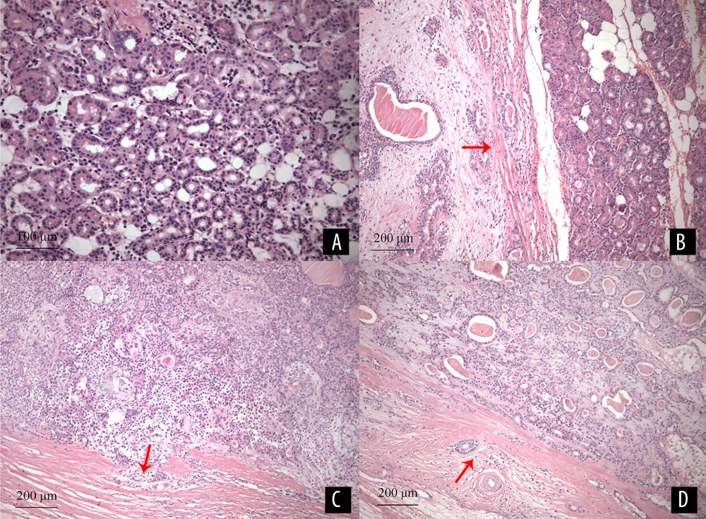 (A) Normal lacrimal glands are mainly composed of acinars and ducts. The acinars are composed of serous glandular cells, the ductal epithelial cells are neatly arranged to form lumens of various sizes, with scattered lymphocytes and blood vessels (HE staining×200). (B) The tumor tissues are a mixture of glandular epithelium, myoepithelial cells, and interstitium. The envelope structure of the tumor margin is loose, as indicated by the arrow. The remaining normal lacrimal gland tissues are visible on the right (HE staining ×100). (C) Some glandular epithelial and myoepithelial cells grew outwards and invaded the outside of the capsule with clusters in a “sprouting” manner, as indicated by the arrow (HE staining ×100). (D) the edge of the tumor envelope is roughly even, glandular epithelium, myoepithelial cells, and lymphocytes are scattered in the envelope, as indicated by the arrow (HE staining ×100).