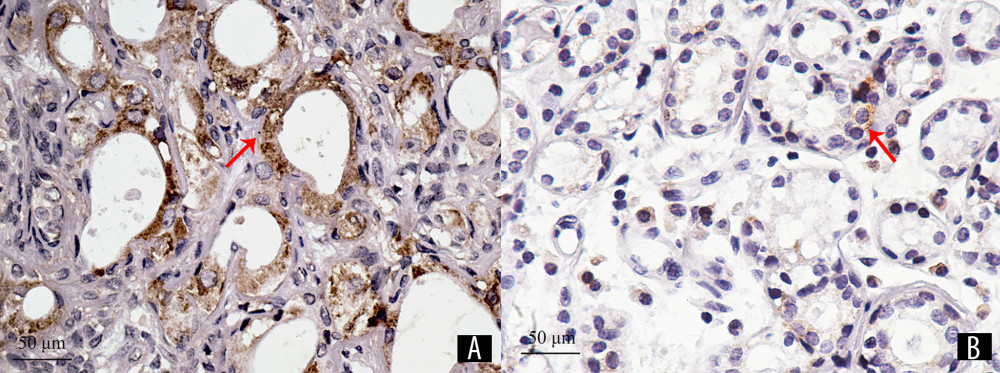 The positive expression products of bcl-2 are brown-yellow particles, mainly located in the cytoplasm of glandular epithelial and myoepithelial cells, as indicated by the arrow. The expression of bcl-2 in the experimental group (A) was 14928.76 pixels and 3975.40 pixels in the control group (B) (immunohistochemical staining×400).