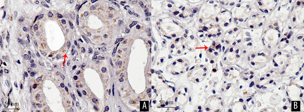 The positive expression products of bax are brown-yellow particles, mainly located in the cytoplasm of glandular epithelial and myoepithelial cells, as indicated by the arrow. The expression of bax in the experimental group (A) was 8364.82 pixels and 5149.36 pixels in the control group (B) (immunohistochemical staining ×400).