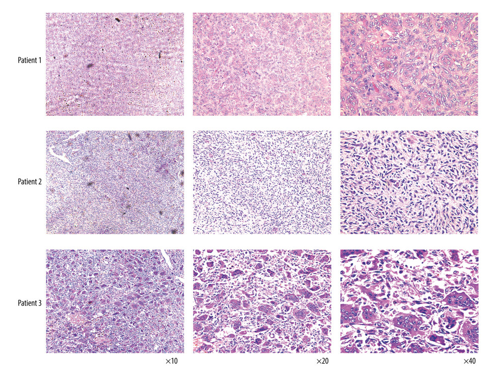 Hematoxylin and eosin (HE) slides and gross specimens of patients in the validation dataset with a histopathological diagnosis of malignant giant cell tumor of bone.
