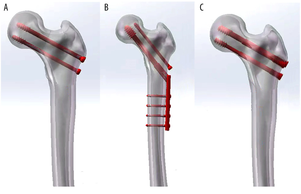 Model of a femoral neck fracture treated with internal fixation in the 3 groups: (A) 3 cannulated screws (3CS); (B) dynamic hip screw and cannulated screw (DHS+CS); (C) bidirectional compression-limited sliding screw (BCLSC).