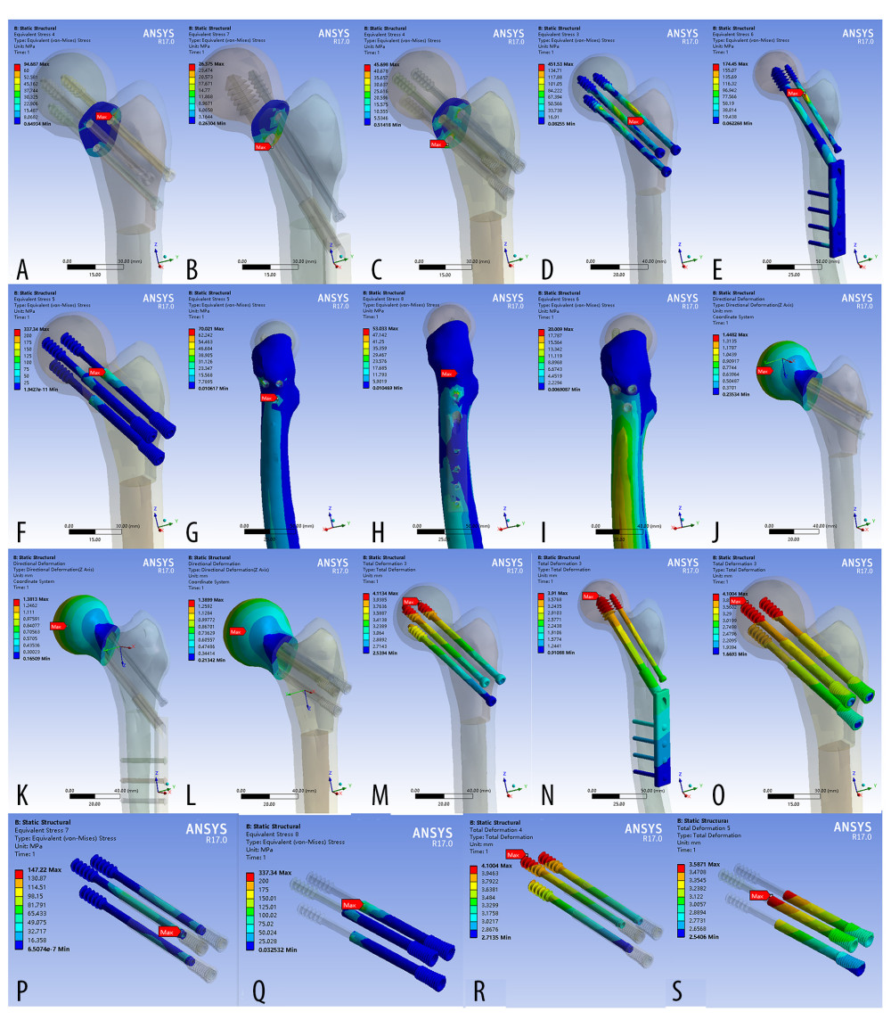 Finite element stress and displacement map of the model. (A–C) Stress distribution map of the fractured bone ends of the finite element model; (D–F) Map of internal fixed stress distribution in the finite element model; (G–I) Map of stress distribution on the lateral femoral wall of the finite element model; (J–L) Distribution map of femoral head displacement in the finite element model; (M–O) Map of internal fixed displacement distribution in the finite element model; (P–Q) Map of stress distribution in the internal structure of the bidirectional compression-limited sliding screw (BCLSC); (R–S) Map of displacement distribution of internal structure of the BCLSC.
