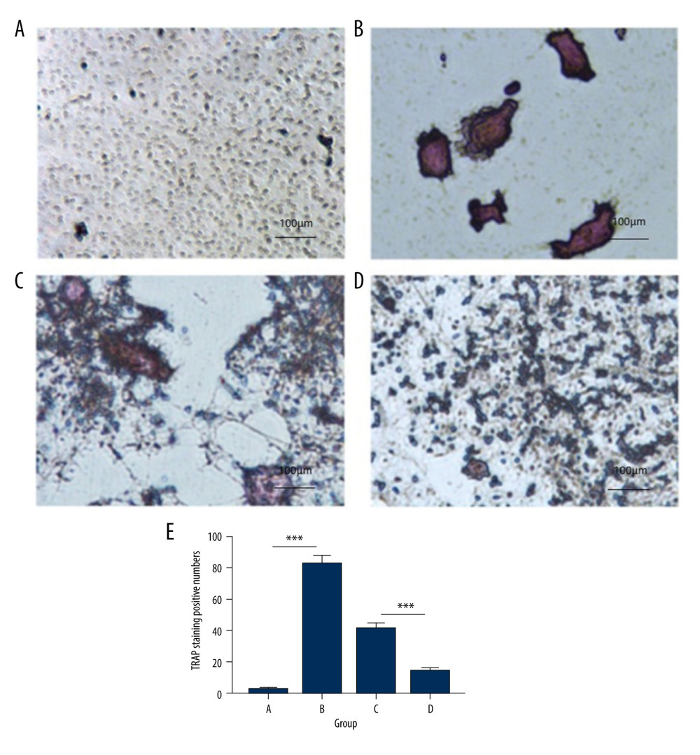 Tartrate-resistant acid phosphatase (TRAP) staining of osteoclasts in different groups (magnification, ×400). (A) Control group exposed to phosphate-buffered saline (PBS). (B) Cells exposed to receptor activator of nuclear factor (NF)-κB ligand (RANKL) and macrophage colony-stimulating factor (M-CSF) for osteoclast induction. (C) Empty vector group exposed to RANKL and M-CSF. (D) hsa_circ_0021739 overexpression group exposed to RANKL and M-CSF. (E) Microscopic images showing cell morphology and numbers of TRAP-positive cells. *** P<0.0001.