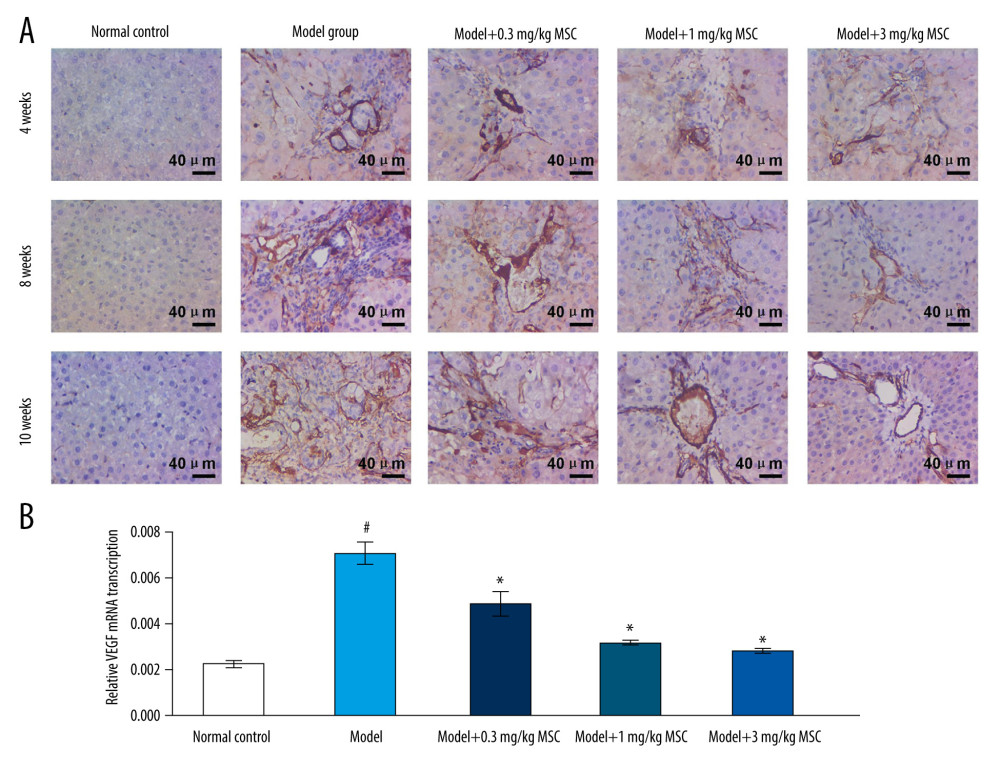 Effects of se-methylselenocysteine (MSC) treatments on vascular endothelial growth factor (VEGF) expression in liver tissues of rats in different groups. (A) Immunohistochemical analysis for evaluating VEGF expression. The scale bars of 200 μm are illustrated in images. (B) RT-PCR assay for assessing VEGF gene transcription. # P<0.05 vs Normal control group. * P<0.05 vs Model group.