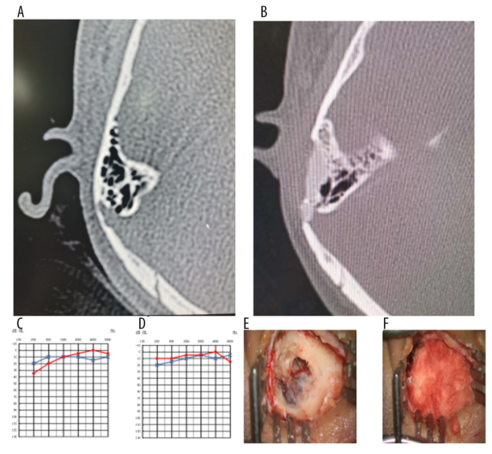 A typical case of sigmoid sinusoidal tinnitus and low-frequency sensorineural hearing loss (right sigmoid sinus diverticulum [SSD]). (A) Preoperative temporal bone computed tomography (CT). (B) Postoperative temporal bone CT. (C) Preoperative pure-tone audiometry (PTA). (D) Postoperative PTA. (E) Intraoperative SSD. (F) After excision of the sigmoid diverticulum during the operation, the autologous bone powder was covered. In PTA, the dotted red line represents the right side; the star blue line represents the variation of the left.