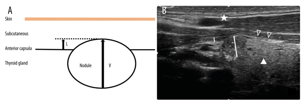 Schematic of the L/V measurement method (A). Actual diagram of L/V measurement method (B). The icons represent subcutaneous tissue (white pentagram), anterior capsula (white hollow triangle) and thyroid gland (white solid triangle) (B). The short double arrow represents the L value, which is the ledge length of the protruding thyroid capsule from the nodule. The long double arrow represents the V value, which is the vertical diameter of the nodule (B).