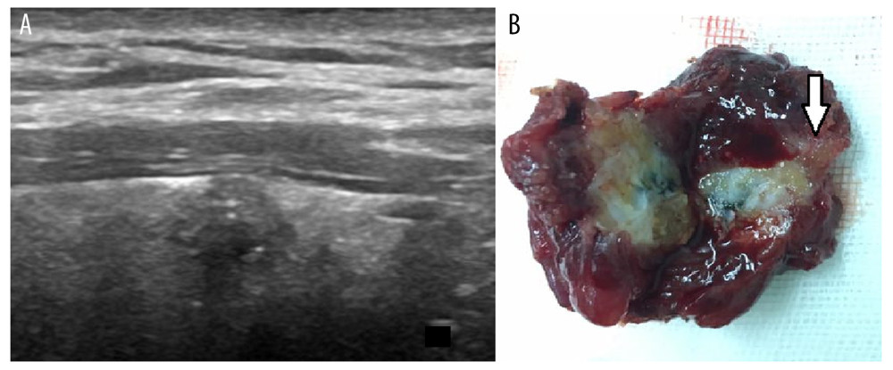 Papillary carcinoma of the thyroid gland with extra-capsular invasion (A). A flat nodule is seen in the thyroid gland with no prominent bulge, and the L/V ratio is 0.17, showing that the tumor invaded the thyroid capsule and the anterior cervical muscle (arrow) (B).