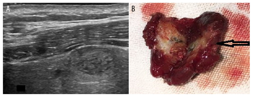 Papillary carcinoma of the thyroid gland without extra-capsular invasion. Ultrasonographic findings of the apparent uplift of the nodule, L/V ratio of 0.34 (A); intact thyroid capsule (B).