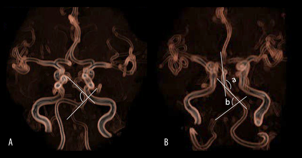 (A) is a schematic diagram to measure the bending angle of the basilar artery. The arrow indicates the angle formed by 2 sides of the basilar artery curvature toward the midline. (B) is a schematic diagram to measure the vertebrobasilar artery minimum angle. Take the smallest angle of the distal base artery or the V4 segment of the vertebral artery in the dissection lesion. The vertebral-basal artery at the distal end of the dissection lesion formed 2 angles, which were the basilar artery bending angle and the vertebral artery bending angle. The vertebral artery angle was 85°, while the basilar artery bending angle was 135°. Therefore, the vertebrobasilar artery minimum angle was 85°.