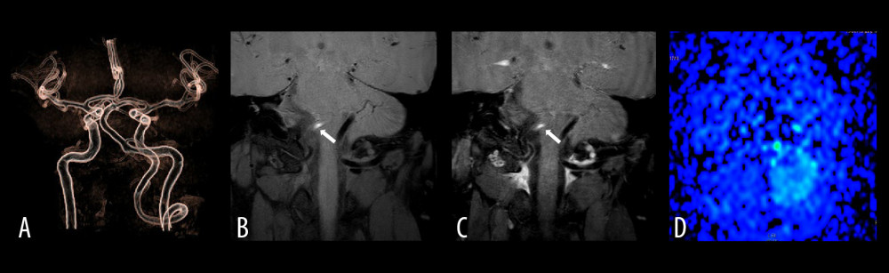 The right vertebral artery V4 proximal dissection images of a 40-year-old female patient with dizziness and instable walking for 6 hours. (A) Is an MRA image. It can be seen that the vertebrobasilar artery minimum angle in this case is the basilar artery bending angle, which is measured to be approximately 75°. (B) Is a T1 VISTA scan image, showing eccentric crescent-shaped high signal at the proximal end of the right vertebral artery. (C) Shows no enhancement of vessel wall after T1 VISTA-enhancement. (D) Is an ASL image, and the right cerebellar hemisphere shows hypoperfusion.