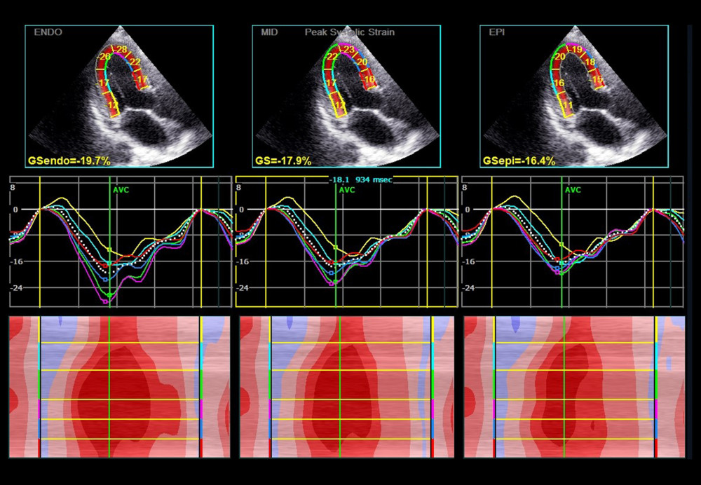 Layer longitudinal peak strain assessed by 2D-STE in a patient with CAD. The first-row panels indicate the global and segment strain from apical long-axis view in endocardium, middle layer, and epicardium. The second-row panels indicate the corresponding segmental strain traces. The lower panels indicate the corresponding qualitative color M-mode strain referring to the 6 consecutive myocardial segments. Dark red, normal strain; light red, decreased strain; and pink color, strongly reduced strain. ENDO – endocardium; MID – middle layer; EPI – epicardium; GS – global strain.