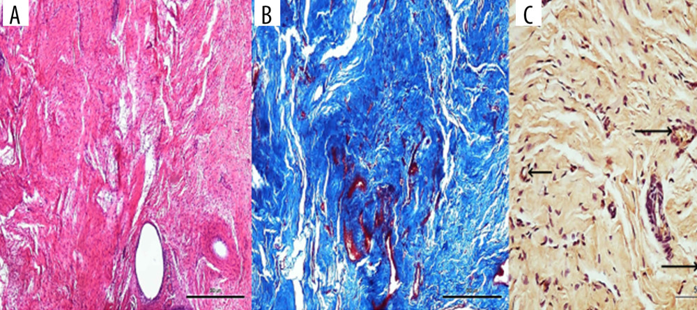 Image from control group at week 6. (A) There is irregularity in the collagen sequence (hematoxylin and eosin stain, 4×). (B) There appears to be a cross in the collagen sequence (Masson trichrome, 4×). (C) Vascular structures (→) marked with vascular endothelial growth factor are seen (20×).