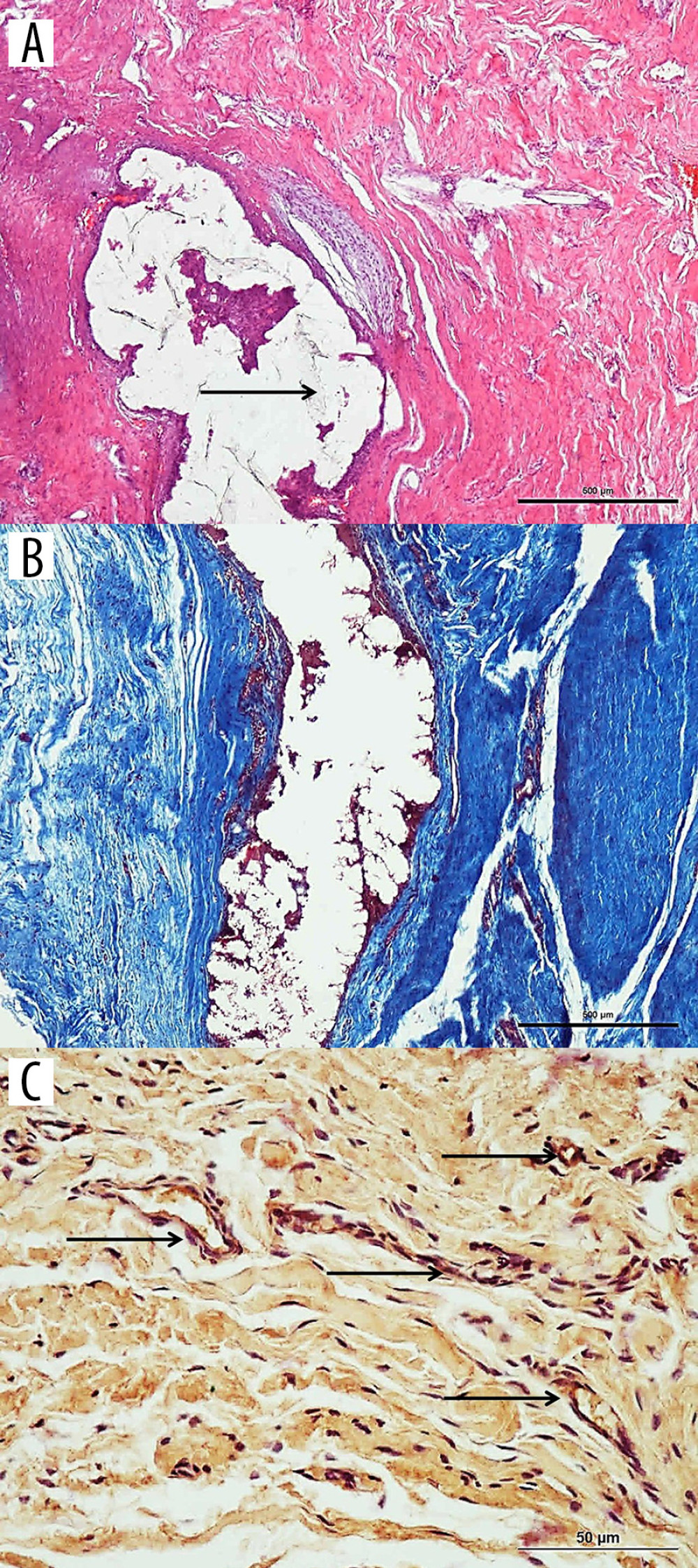 Image from experimental group at week 6. (A) Decreased amount of cyanoacrylate (→) can be seen (hematoxylin and eosin stain, 4×). (B) Irregular collagen sequence is outstanding (Masson trichrome, 4×). (C) It is seen that vascular endothelial growth factor-stained vascular structures (→) were increased at week 6 when compared to other groups (20×).