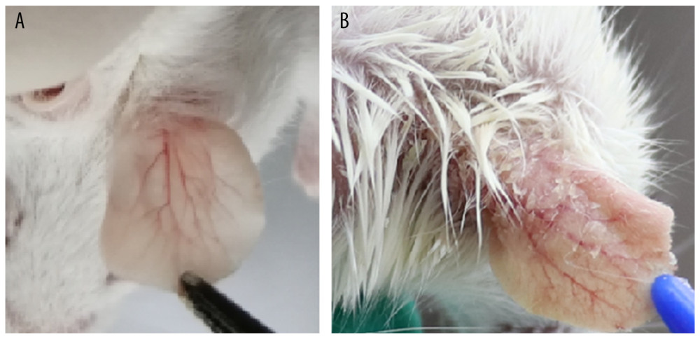 (A) Right ear skin of normal and (B) IMQ groups. The IMQ group exhibited thicker ear skin, increased scaling, and erythema than the normal group.