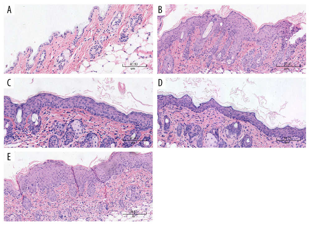 Histological examinations of the skin sections stained with hematoxylin-eosin (Magnification: 200×). (A) Normal mice. (B) The skin sections of the imiquimod (IMQ) group exhibited epidermal thickening, hyperkeratosis, parakeratosis, and inflammation in the dermis. (C, D) The hyperkeratosis and acanthosis in the pGP3 (IM-pGP3) and pGP3M (IM-pGP3M) intramuscular injection groups were milder than that in the IMQ group and (E) the phosphate-buffered saline intramuscular injection group.