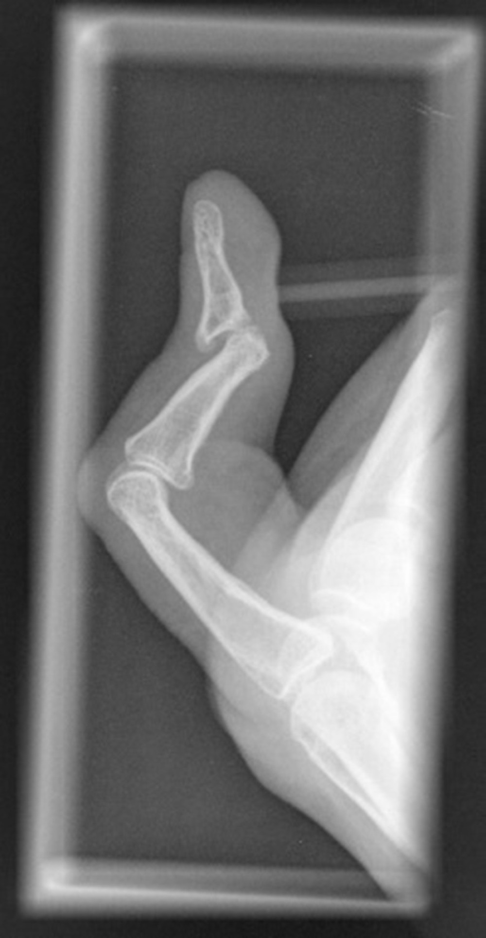 X-ray of the contracted proximal interphalangeal joint.
