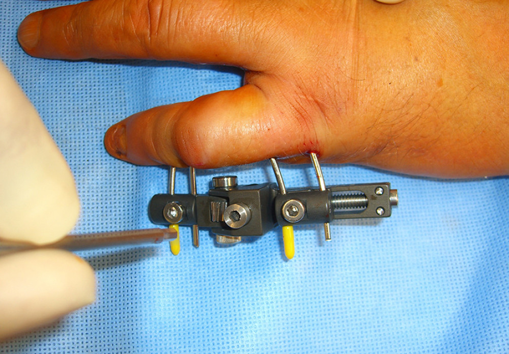 Intraoperative image of the applied distraction device.