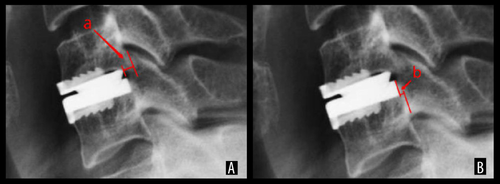 Sagittal alignment accuracy of the prosthesis evaluated by X-ray. This demonstrated that insufficient coverage of the endplate in depth. The upper prosthesis-endplate error distance (A). The lower prosthesis-endplate error distance (B).